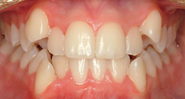orthodontic correction of crowded teeth