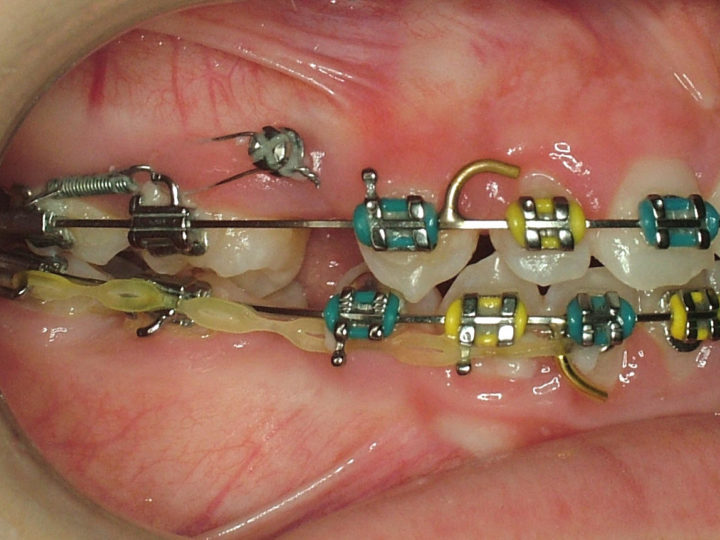 Functional braces North Sydney Orthodontics