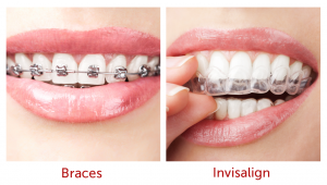 traditional braces vs invisalign