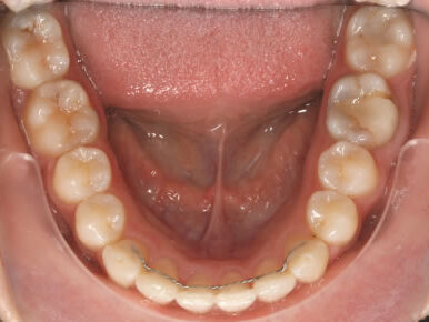 aligned%20wisdom%20tooth2.jpg