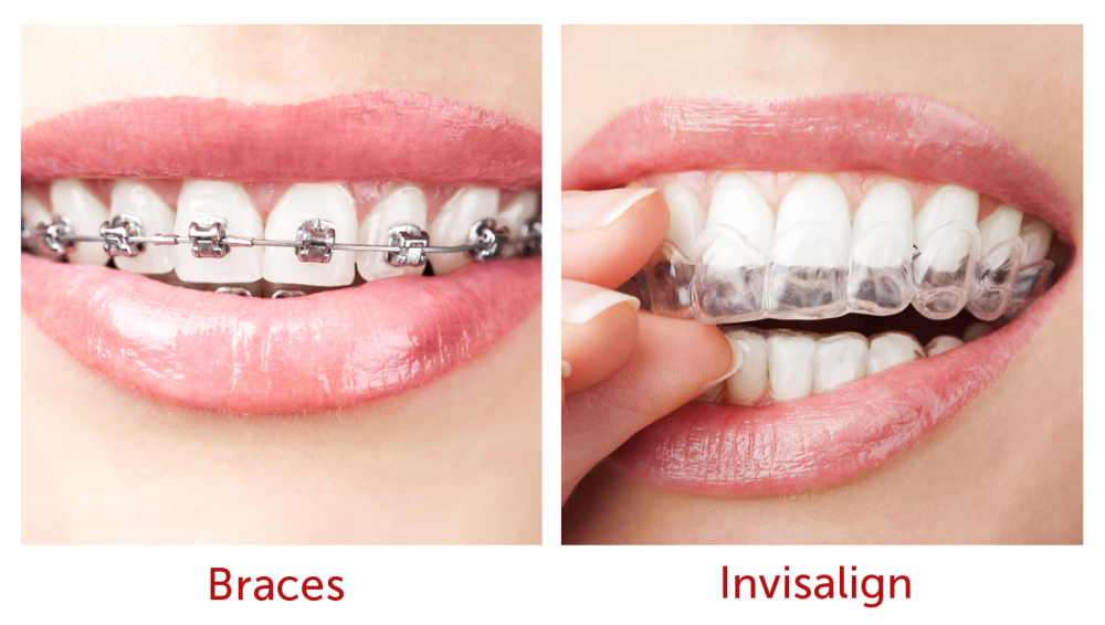 North Sydney Orthodontics Invisalign - North Sydney Orthodontics