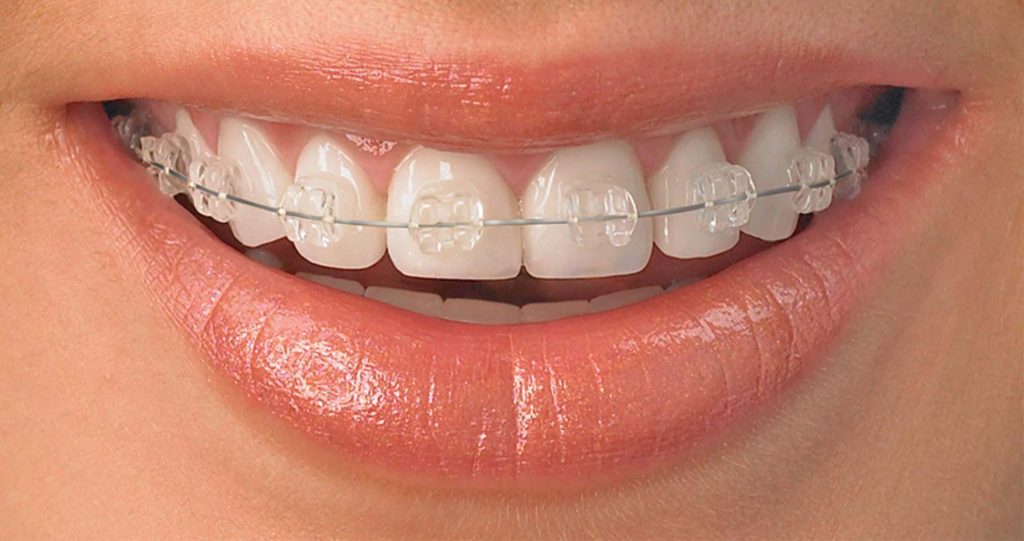 Removable Orthodontics