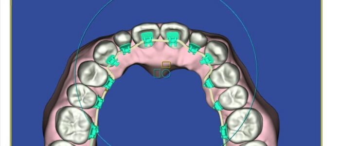 lingual braces setup