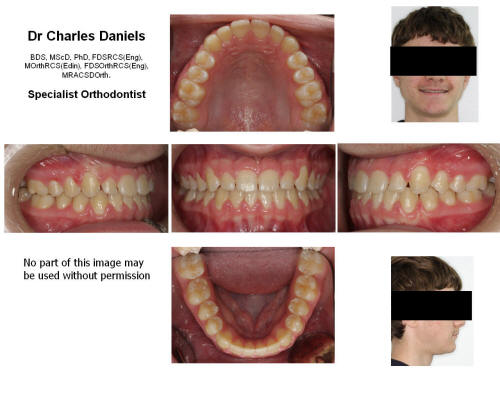 After treatment  with standard orthodontic braces to upper and lower teeth. Treated in 18 months 