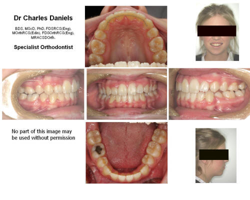 After treatment with rapid palatal expansion, extraction of 4 premolars and stanard orthodontic braces to upper and lower teeth 30 months 
