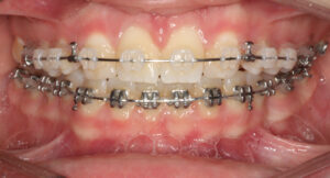 Sydney Fixed braces