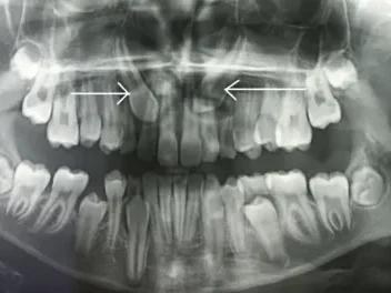 Panoramic-Observation-2017_10_20-2_1 Panoramic dental X-ray with arrows highlighting a gap between the upper central incisors (midline diastema).