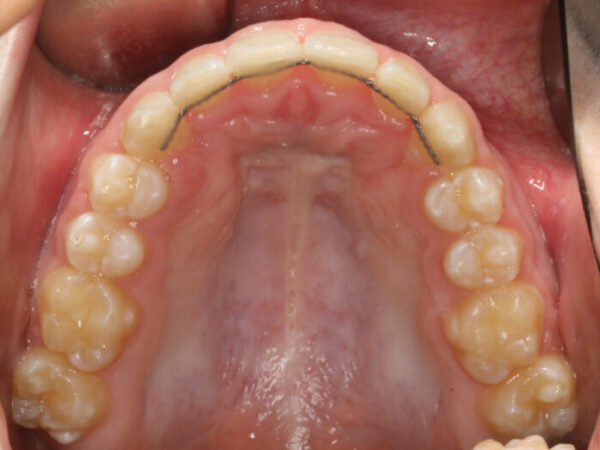 Upper Occlusal-Final-2019_12_20-0_8 View of the upper dental arch from above showing a fixed palatal appliance: a stainless-steel wire (lingual arch) attached to molars on both sides along the palate.