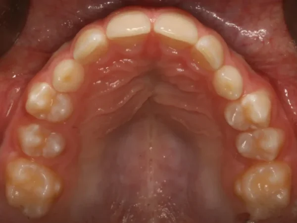 Upper Occlusal-Observation-2017_10_20-0_2 Top view of the upper dental arch showing crowded, misaligned teeth and pink gums during an intraoral exam