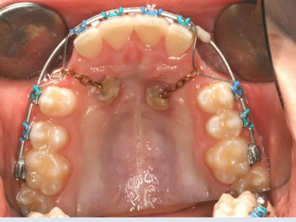 Upper Occlusal-Progress-2018_04_06-0_4 Upper dental arch with braces and blue elastics, showing a palatal view and molar bands with gold chains in place for orthodontic treatment.