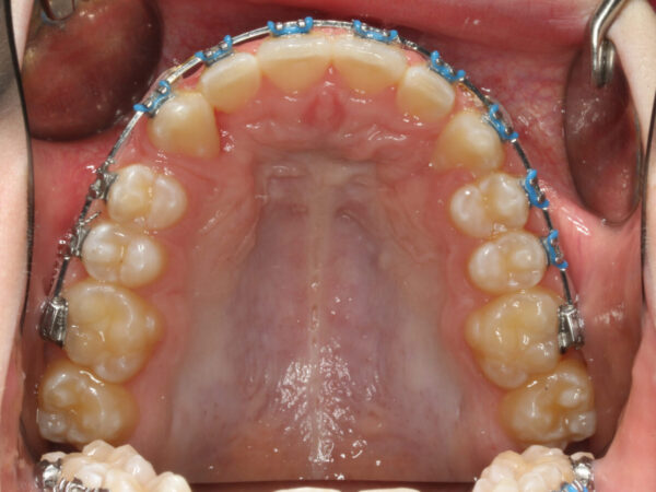 Upper Occlusal-Progress-2019_07_03-0_7 Close-up of the upper dental arch showing braces with metal brackets, white wires, and blue elastic ligatures.