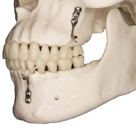 Side view of a dental plaster model showing metal orthodontic braces and wiring on the teeth and jaw.