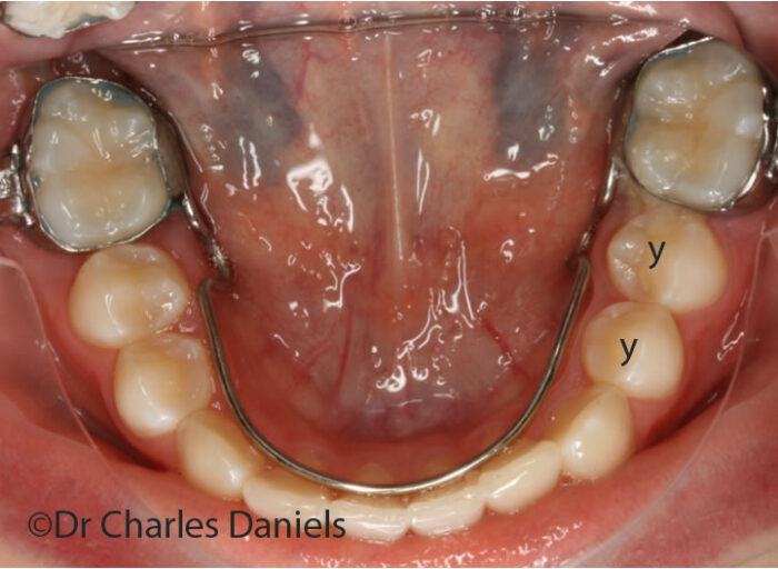 spacemaintainer2 Orthodontic treatment result of spontaneous improvement in alignment during space maintainence