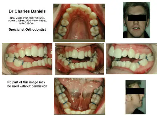 y61a severe Class III jaw relationship before orthodontics and jaw surgery