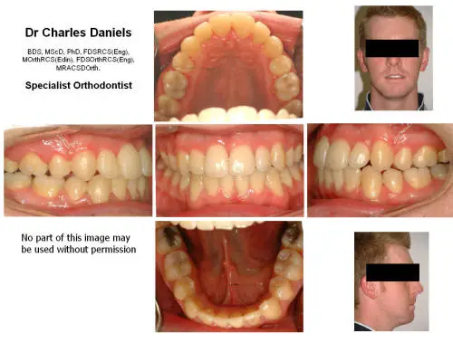 y61b Treatment result after orthodontics and jaw surgery