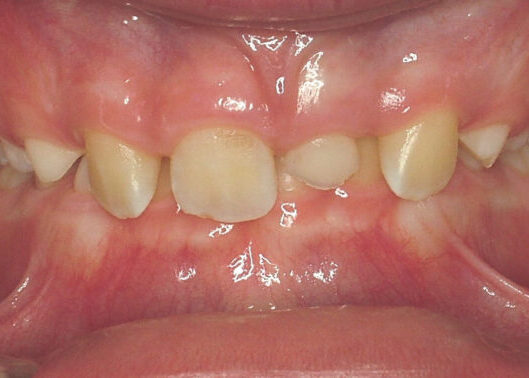 00014219RJ Close-up of the inside of a mouth showing crowded, misaligned upper front teeth and a gap where a tooth is missing; gums are pink and moist.