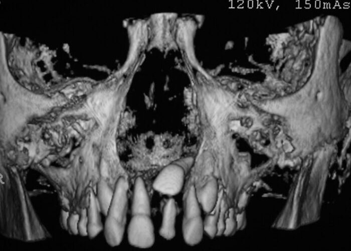 0001426TZZ CBCT coronal view of the maxillofacial region showing teeth and a dental implant in the lower anterior jaw with surrounding bone loss.