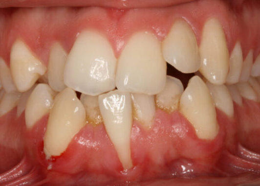 0002958EGW Close-up of a mouth with severe dental crowding and misaligned teeth; several teeth are rotated and overlapping, especially the front teeth, with reddened gums.