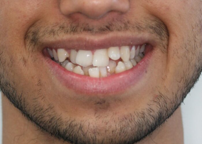 000295OYQF1 Close-up of a mouth showing crowded, misaligned teeth with a slight smile and visible facial stubble? on chin??