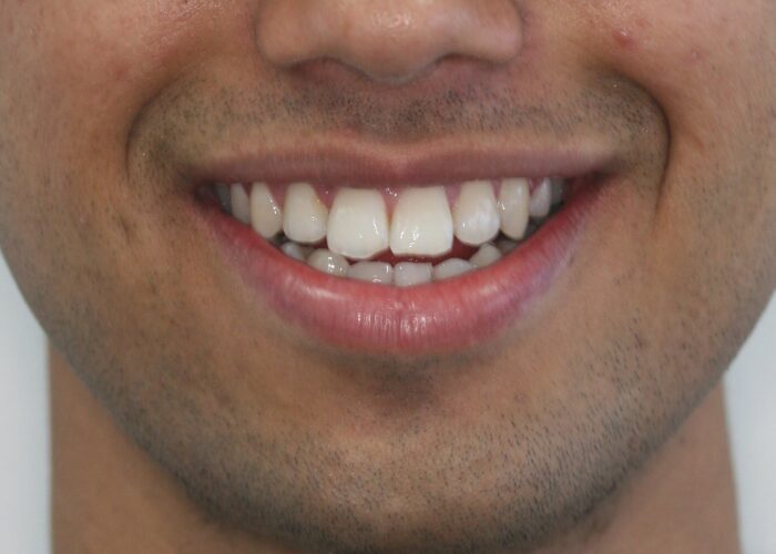 000295OYQF2 Close-up of an adult man's smile showing white upper teeth and visible lower teeth with light stubble on the chin and cheeks around the mouth.