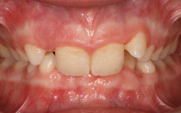 000329APCO Close-up of a mouth showing crowded upper front teeth and reddened gum tissue.