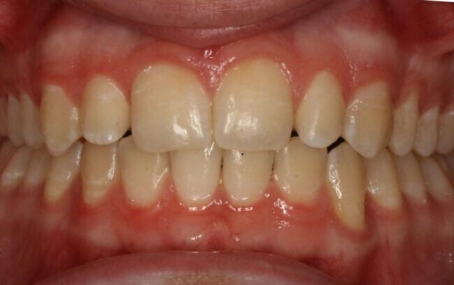000329M3CK Close-up of upper and lower teeth showing mild crowding and red, inflamed gums around the front teeth.