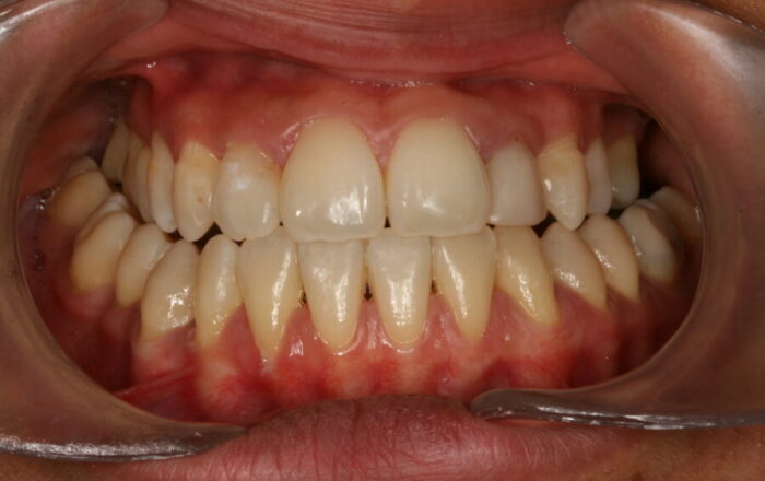 0005076DIB Close-up of an open mouth showing upper and lower front teeth with mild crowding and red, inflamed gums along the front of the upper jaw and lower incisors.