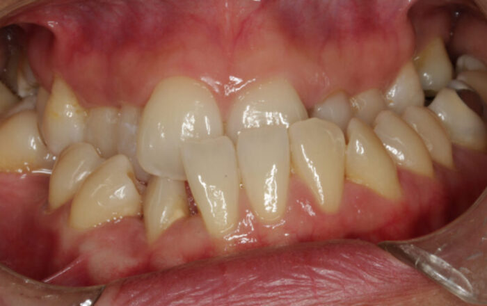 0005079UMN Close-up of a crowded upper dental arch with overlapping front teeth and inflamed red gums.