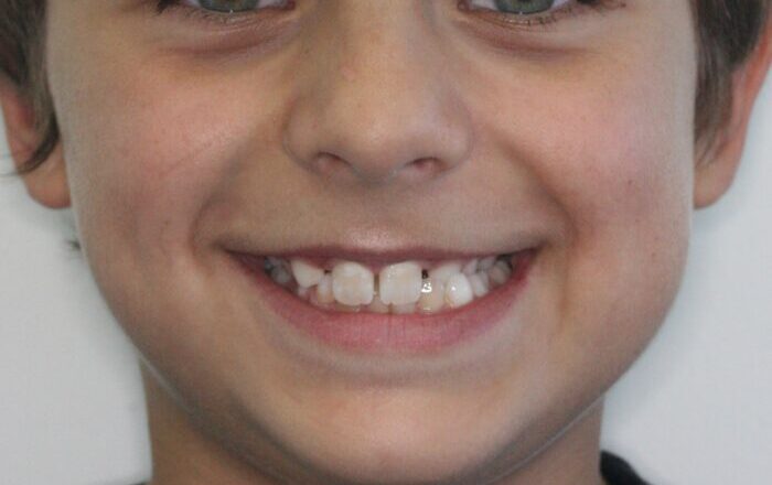 0006951VO4 1 Close-up of a person smiling, showing upper teeth and lips with the nose and cheeks partially visible.
