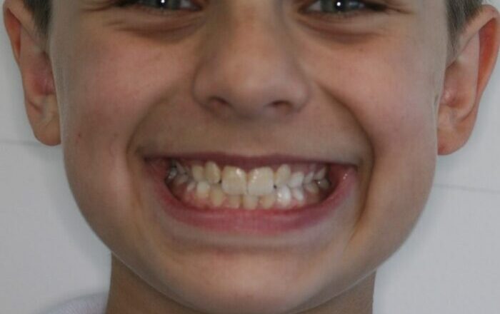 0006957FV7 2 Close-up of a boy smiling, revealing crowded, misaligned upper and lower teeth.