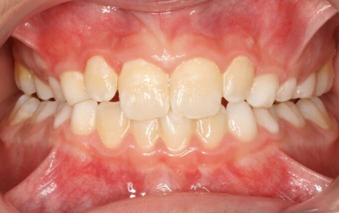000695Z11M Intraoral photo showing crowded, misaligned upper and lower front teeth with slight overlap and bite misalignment inside the mouth