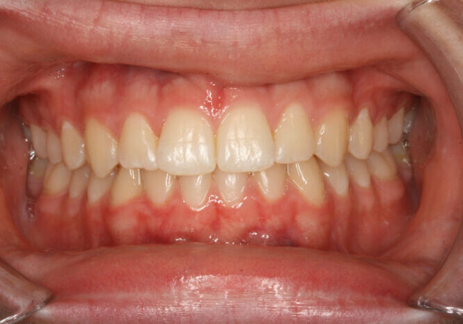 0008439B7O Close-up of a smiling mouth with lips pulled back, showing front teeth and pink gums with mild inflammation at the gumline.