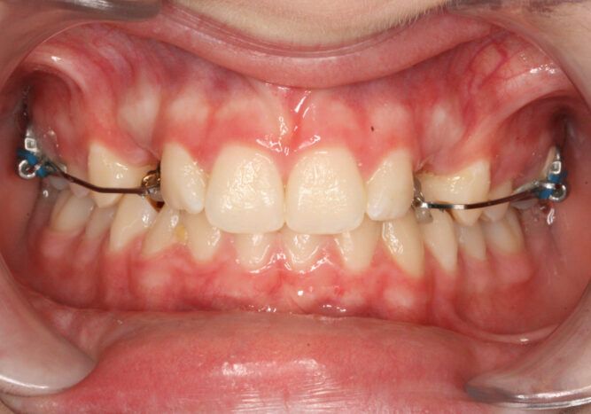 000843UPWA Close-up of a patient’s open mouth showing braces on upper and lower teeth, with red, inflamed gums around the front teeth.