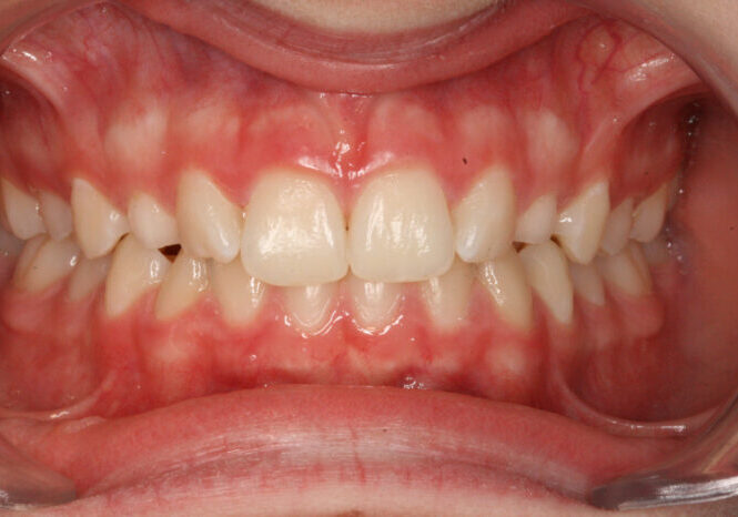 000843X5T2 Close-up of a mouth showing inflamed, reddened gums around the front teeth (gingivitis).