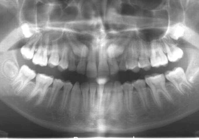000843XJDR Panoramic dental X-ray of the upper and lower jaws showing teeth and surrounding bone structure.