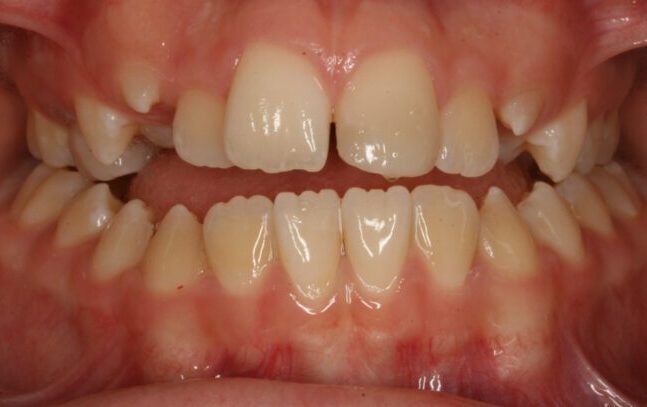 000899BKJL Close-up of a mouth showing a gap between the upper front teeth and crowded lower teeth with a misaligned bite.