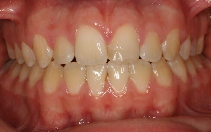 000899XAHF Close-up of a smiling mouth showing crowded anterior teeth and pink, inflamed gums.