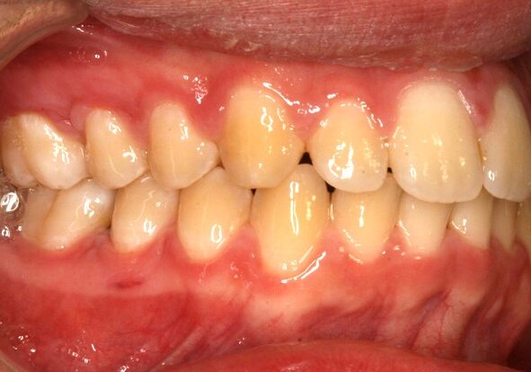 001158AUIW Close-up of the front teeth with red, inflamed gums, lips held back by a dental retractor.