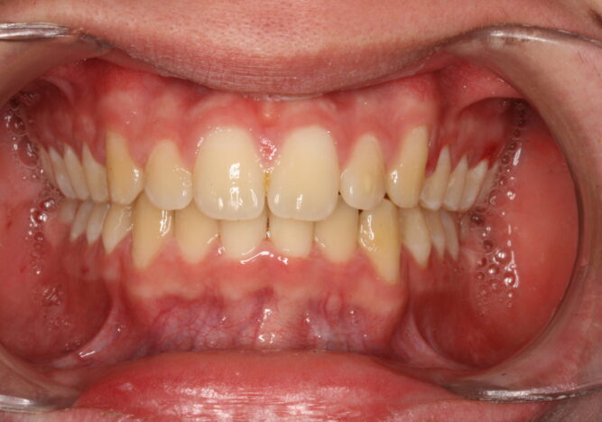 001158J3WW Close-up of an open mouth showing red, swollen gums around the upper front teeth.