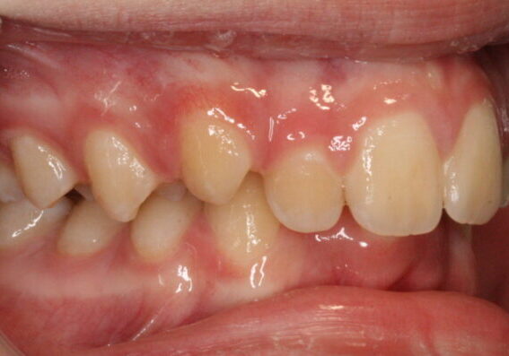 001158Z3FW Close-up of the lower dental arch showing mildly inflamed, red gums around the front teeth.