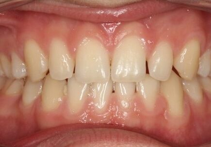 0013046MK6 Close-up of a patient’s mouth with lips retracted, showing upper and lower teeth and pink gums.