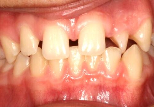 001304D8DH Close-up of upper front teeth with a gap between the central incisors and crowding of lower teeth