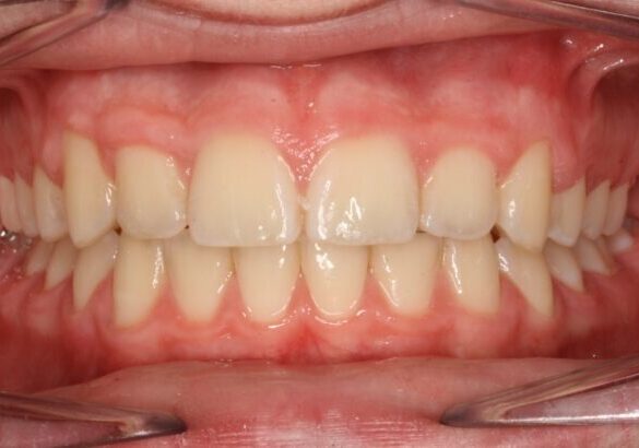 0015147EDY Close-up of an open mouth showing upper and lower teeth with pink, slightly inflamed gums around the front teeth.