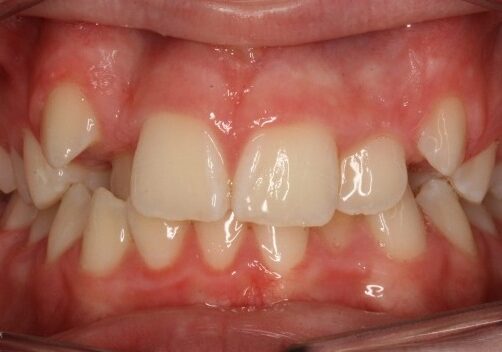 001514LYAU Front view of a mouth with crowded, misaligned upper and lower teeth and red, inflamed gums indicating dental malocclusion.