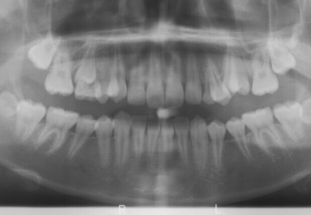 001766A3UI Panoramic dental X-ray showing upper and lower jaws with all teeth visible; mild crowding of the front lower teeth is noted.