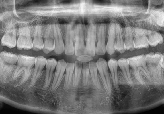 001766E1FY Panoramic dental X-ray showing full upper and lower teeth and jaw structures for exam and assessment