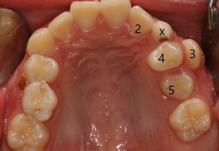 001766Y3Q2 Top view of the upper dental arch with teeth labeled 2, the damaged tooth marked x, then 3, 4, and 5.