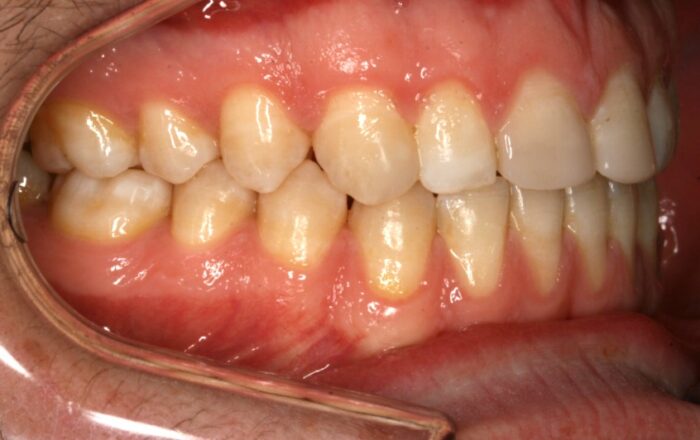 001851KL4L Close-up of a patient’s lower front teeth and upper gumline showing pink, slightly swollen gums with mild inflammation near the incisors, measured with a dental cheek retractor in place.