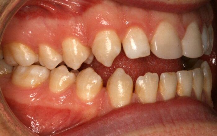 001851U70B Close-up side view of crowded upper and lower teeth with red, inflamed gums (orthodontic alignment issue).
