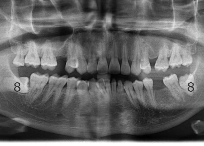 002063AMF9 Panoramic dental X-ray showing upper and lower teeth with surrounding jawbone.
